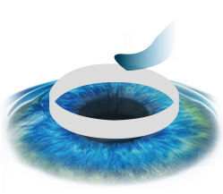 LASIK